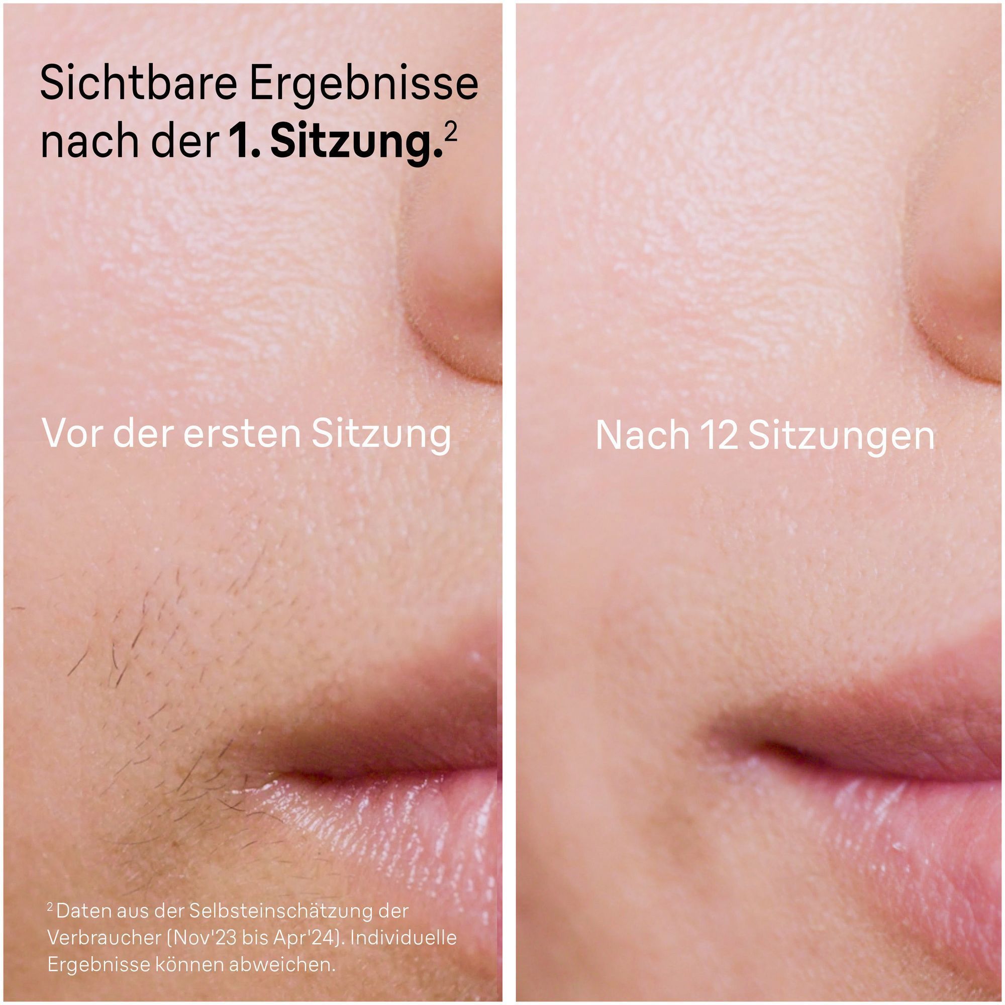 Haarreduktion mit Braun IPL: Sichtbare Ergebnisse nach der ersten Sitzung vs. haarfreie Haut nach 12 Sitzungen.