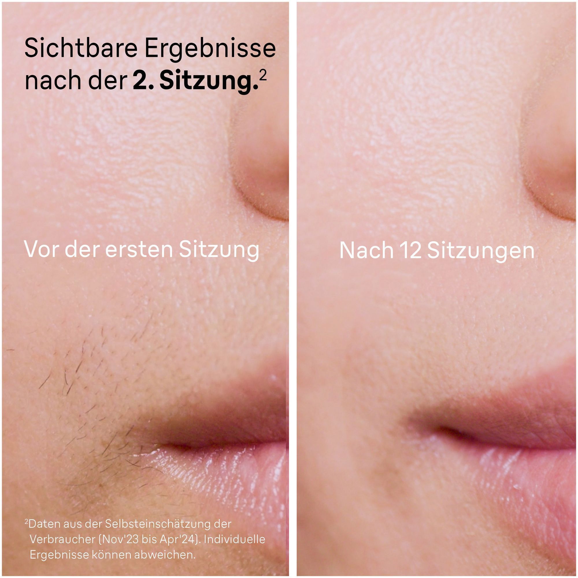 Haarfreiheit mit Braun IPL: Vorher/Nachher-Vergleich nach 2 und 12 Sitzungen. 100-Tage-Geld-zurück-Garantie.