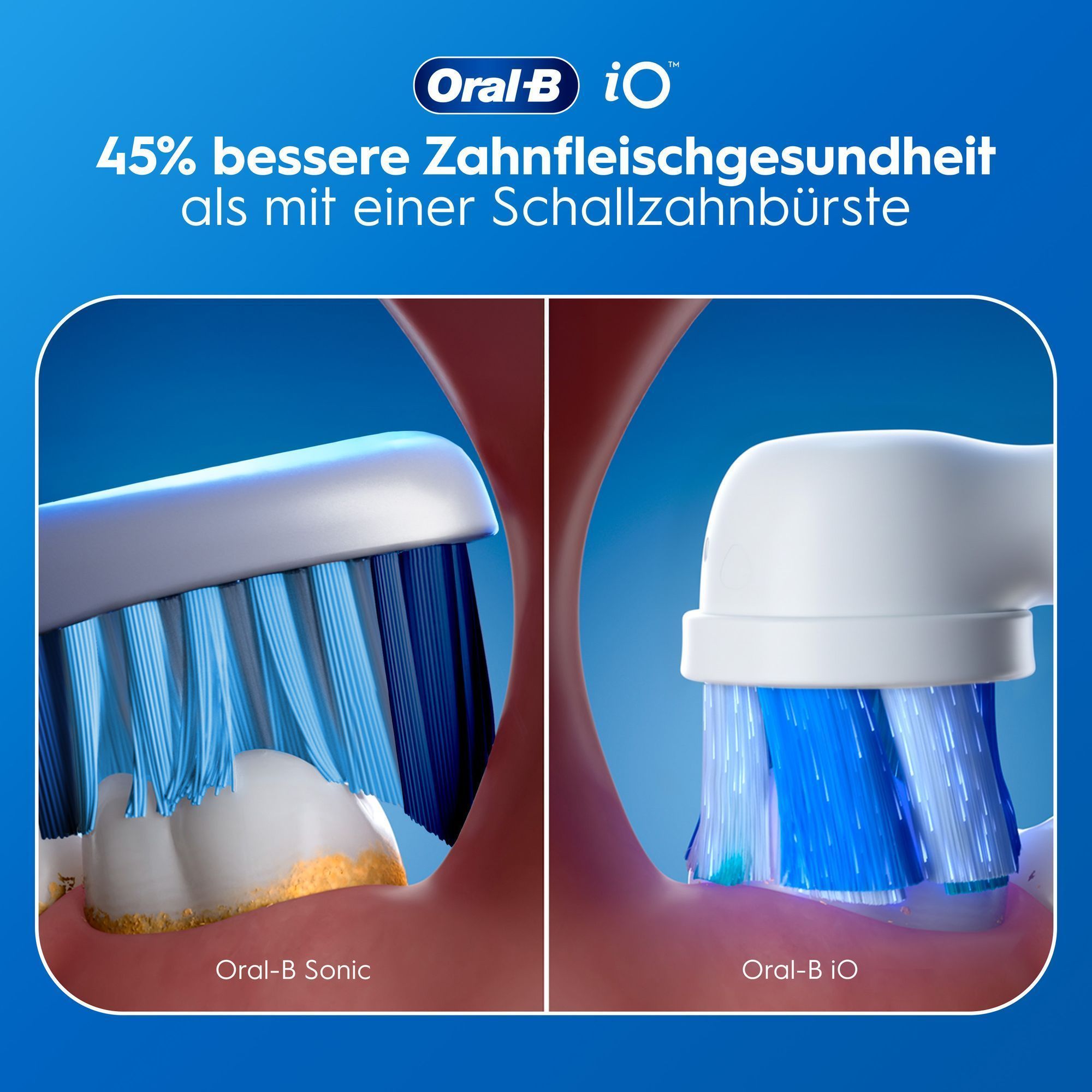 Oral-B iO Bürste demonstriert 45% bessere Zahnfleischgesundheit als Schallzahnbürste.